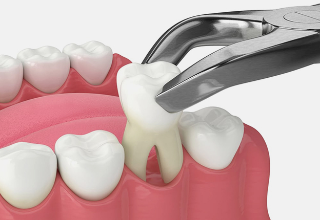 Modern Dentistry of Jupiter | Tooth Extraction