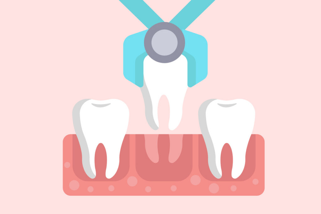 Modern Dentistry of Jupiter | 3 Important Reasons a Tooth Extraction in West Palm Beach is Necessary Modern Dentistry of Jupiter | 3 Important Reasons a Tooth Extraction in West Palm Beach is Necessary