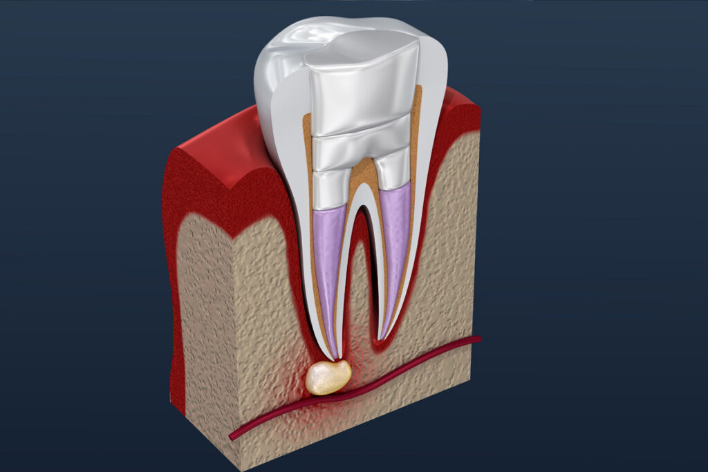 Modern Dentistry of Jupiter | 3 Proven Ways to Overcome Root Canal Fear in Jupiter Modern Dentistry of Jupiter | 3 Proven Ways to Overcome Root Canal Fear in Jupiter