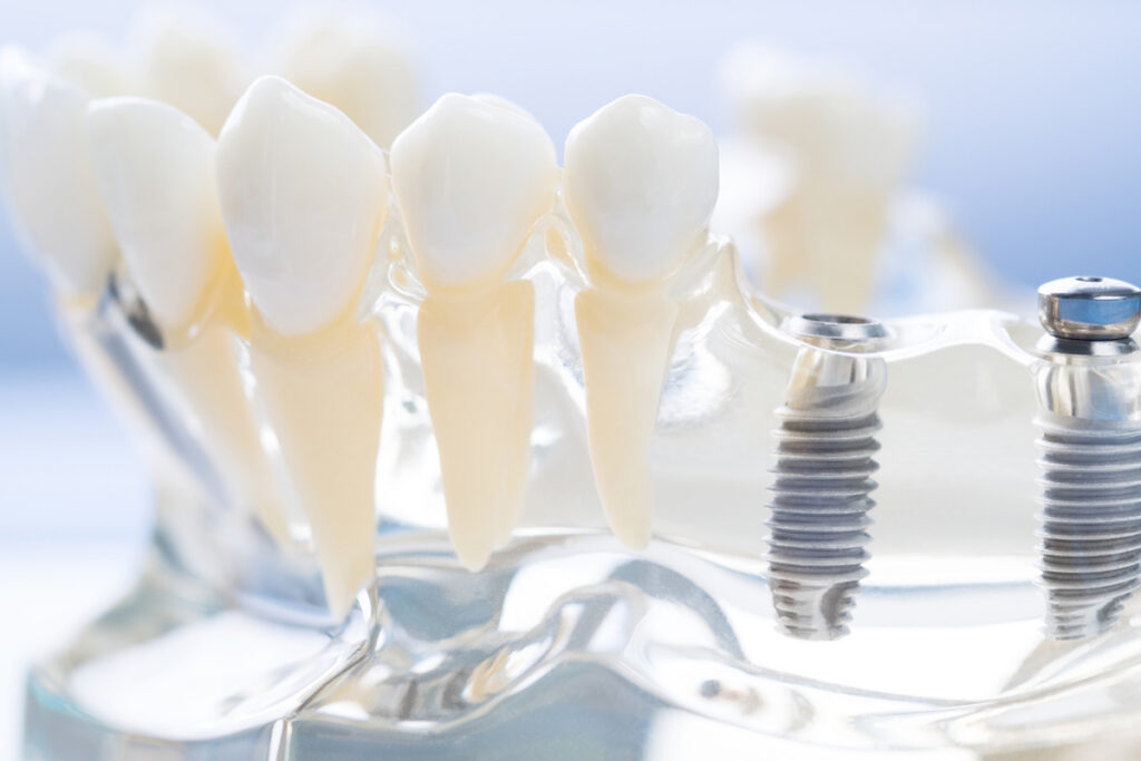 Modern Dentistry of Jupiter | 3 Tremendous Benefits of Dental Implants in West Palm Beach Modern Dentistry of Jupiter | 3 Tremendous Benefits of Dental Implants in West Palm Beach