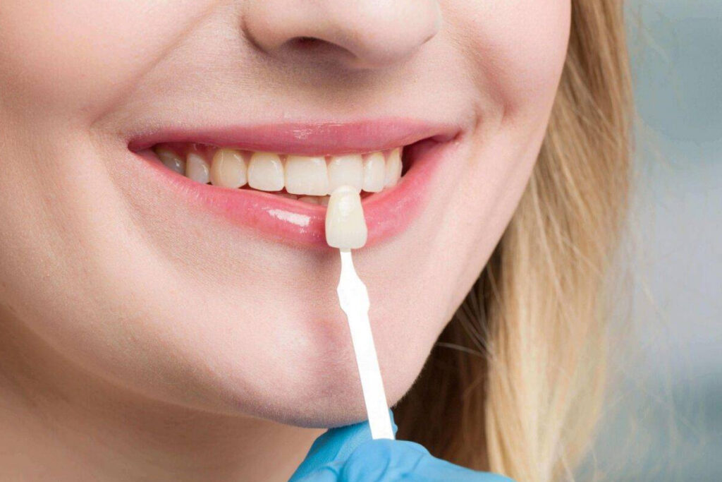 Modern Dentistry of Jupiter | Are Veneers Right for You? Find Out Today!