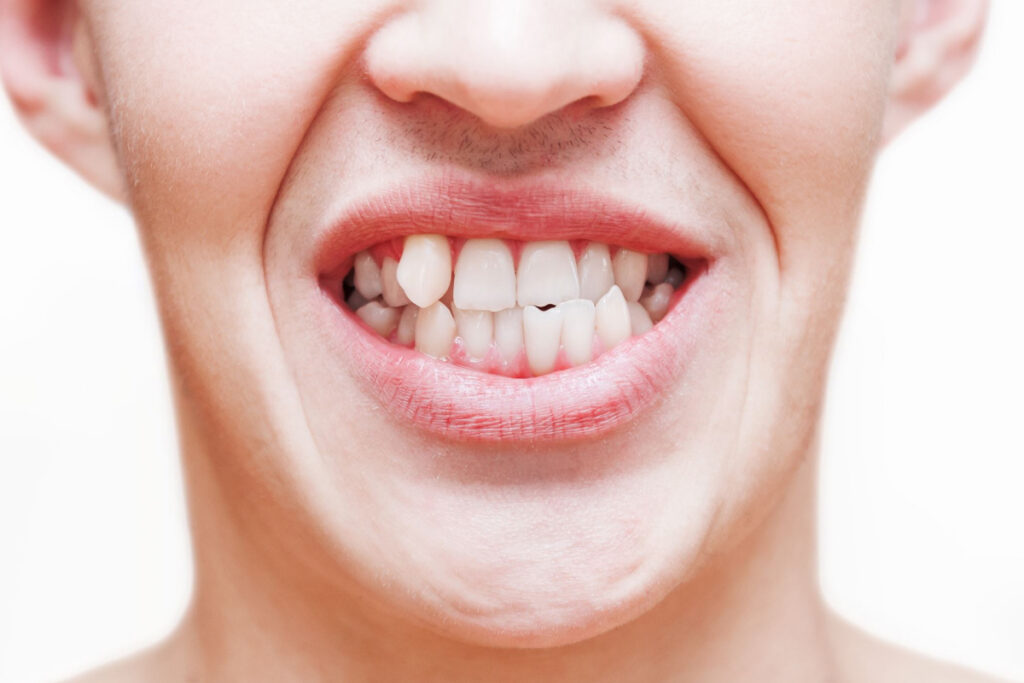 Modern Dentistry of Jupiter | Can Cosmetic Dentistry in Jupiter Fix Crooked Teeth? Modern Dentistry of Jupiter | Can Cosmetic Dentistry in Jupiter Fix Crooked Teeth?