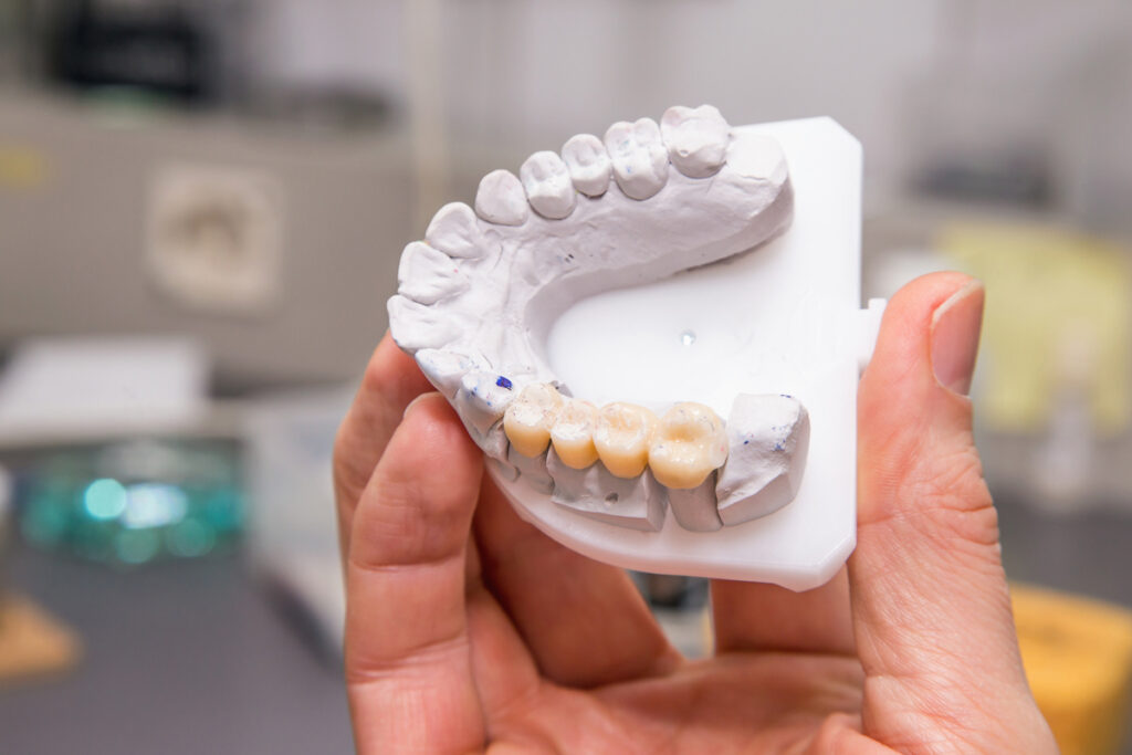 Modern Dentistry of Jupiter | Cosmetic Dentistry in Jupiter: Do You Need Dental Bridges? Modern Dentistry of Jupiter | Cosmetic Dentistry in Jupiter: Do You Need Dental Bridges?