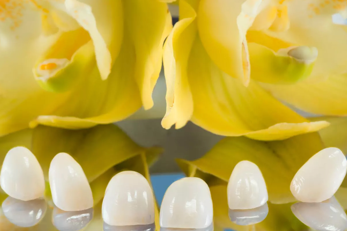 Modern Dentistry of Jupiter | Preparing for Veneers: What You Need to Know