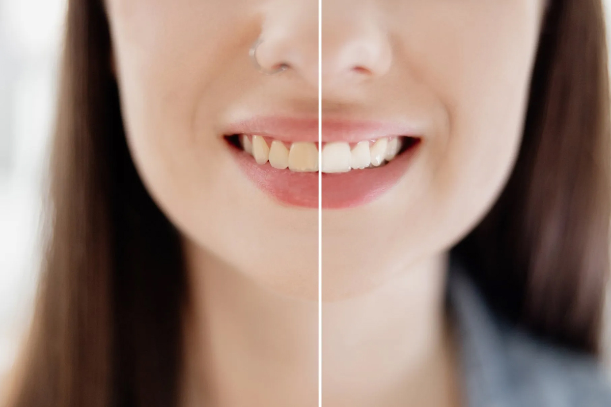 Modern Dentistry of Jupiter | What Are the Benefits of Teeth Whitening in West Palm Beach?