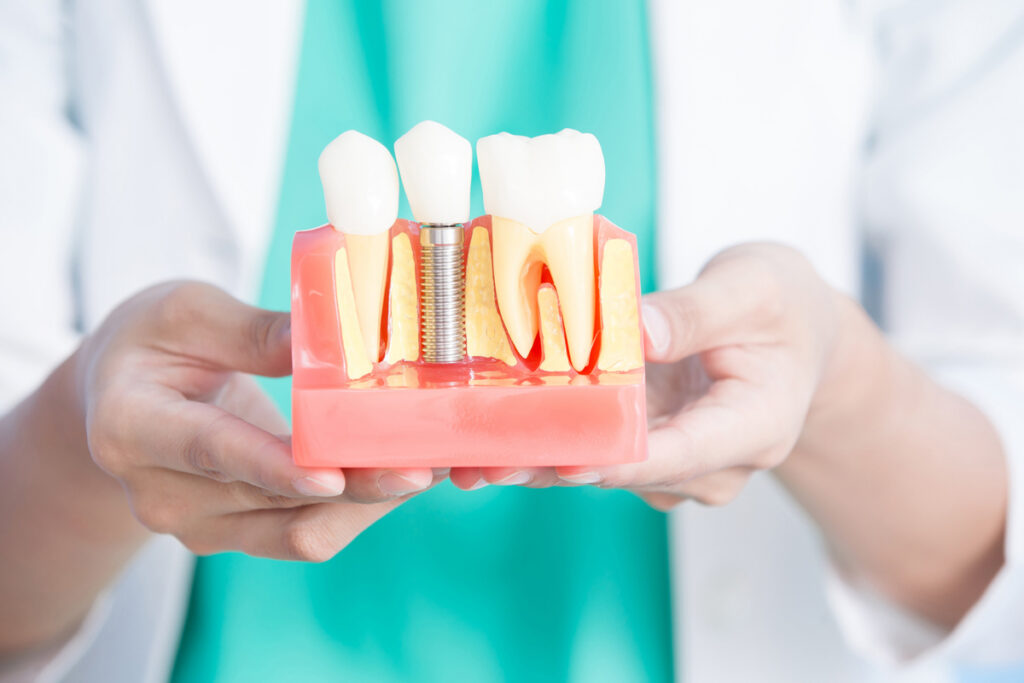 Modern Dentistry of Jupiter | Top Benefits of Dental Implants in West Palm Beach Modern Dentistry of Jupiter | Top Benefits of Dental Implants in West Palm Beach