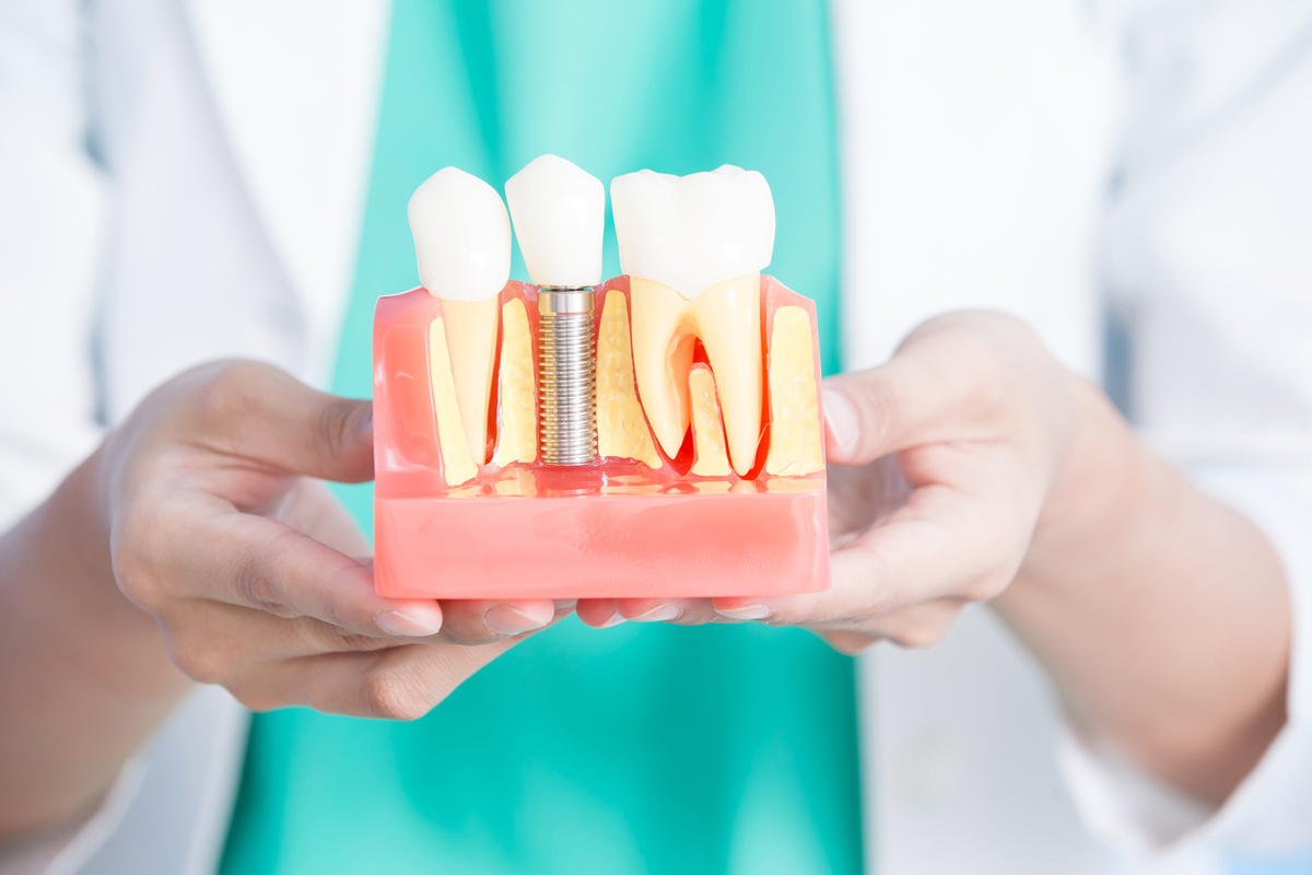 Modern Dentistry of Jupiter | Top Benefits of Dental Implants in West Palm Beach