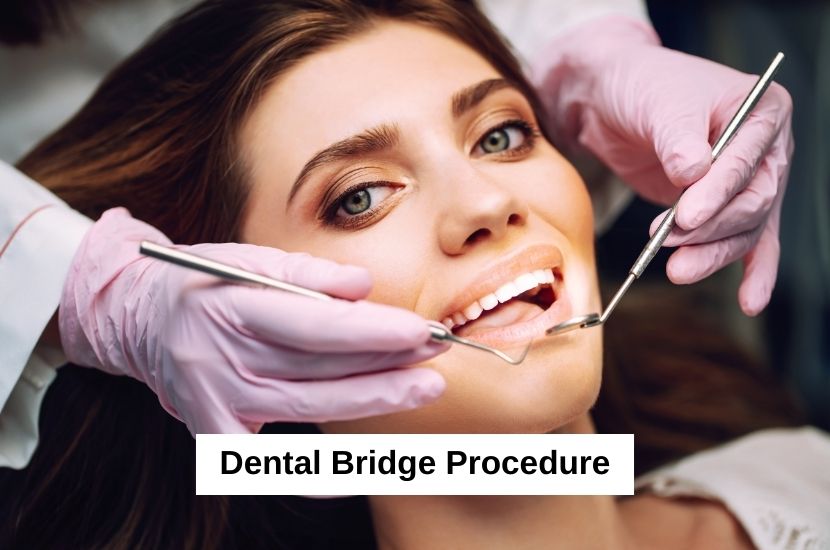 Modern Dentistry of Jupiter | Dental Bridge Procedure: Everything You Need to Know