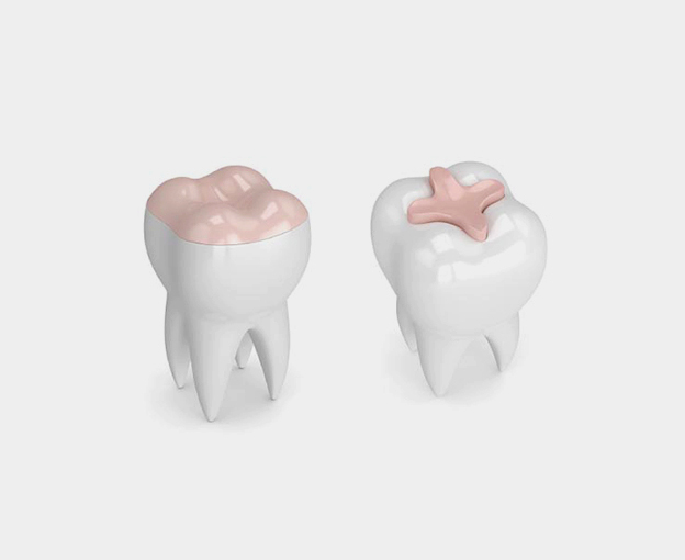 Modern Dentistry of Jupiter | Dental Inlays & Onlays