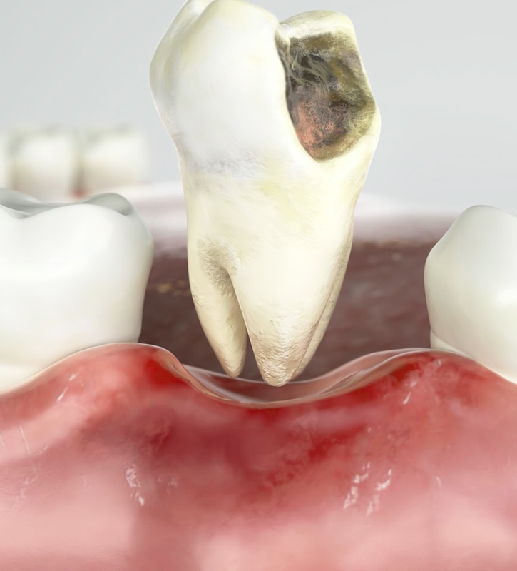 Modern Dentistry of Jupiter | Dentoalveolar Surgery