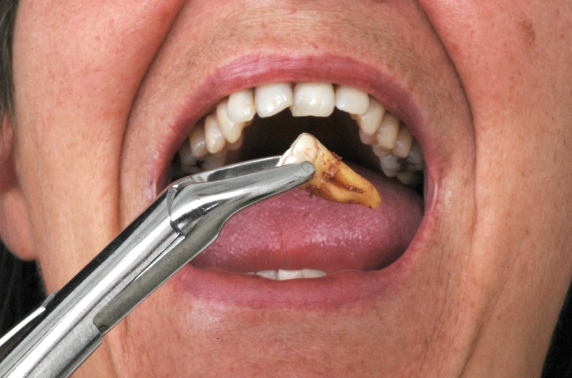 Modern Dentistry of Jupiter | What You Shouldn't Eat Or Drink After Tooth Extraction Modern Dentistry of Jupiter | What You Shouldn't Eat Or Drink After Tooth Extraction