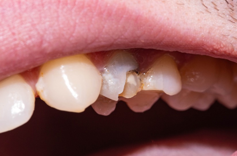 Modern Dentistry of Jupiter | Is a Black Tooth an Emergency?