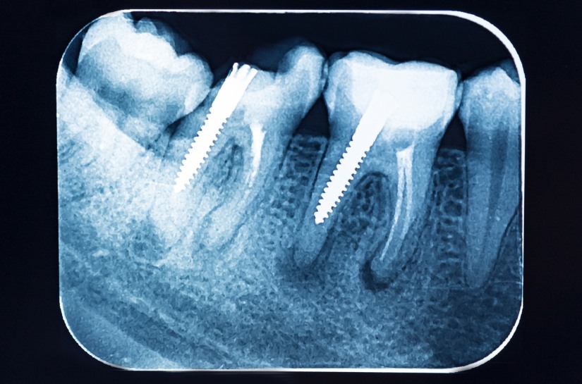 Modern Dentistry of Jupiter | The Truth about Dental X-Rays: How Often is Enough?