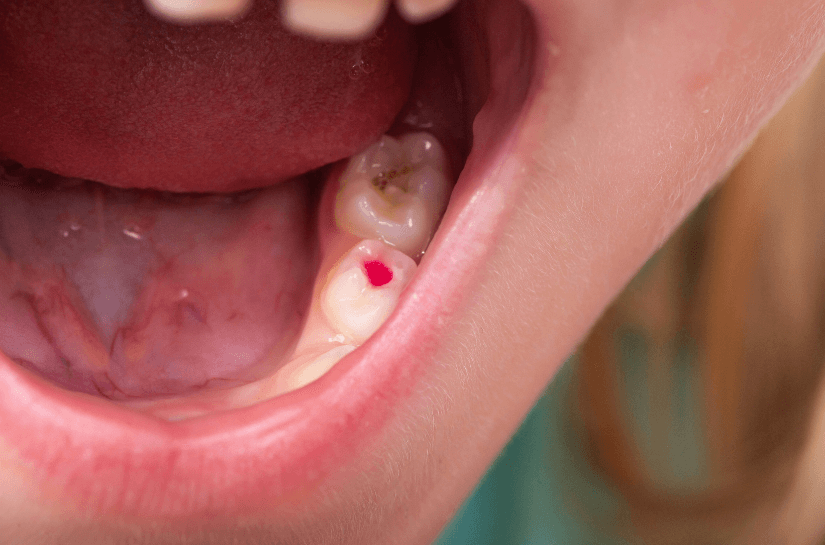Modern Dentistry of Jupiter | Irreversible Pulpitis: Causes And Treatment Modern Dentistry of Jupiter | Irreversible Pulpitis: Causes And Treatment