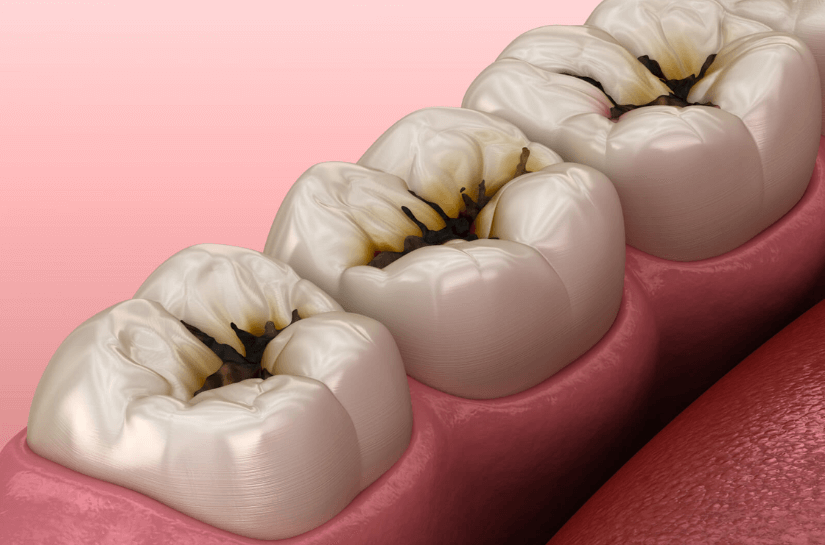 Modern Dentistry of Jupiter | Reversible Pulpitis: Symptoms and Treatments