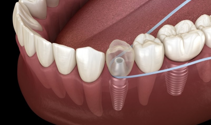 Modern Dentistry of Jupiter | How to Floss with Dental Implants Effectively?