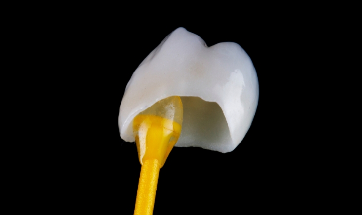 Modern Dentistry of Jupiter | Understanding Dental Crown Maintenance: Tips from Jupiter Dentist Modern Dentistry of Jupiter | Understanding Dental Crown Maintenance: Tips from Jupiter Dentist