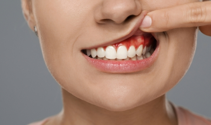 Modern Dentistry of Jupiter | Signs You Might Need Gum Grafting