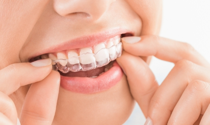 Modern Dentistry of Jupiter | Teeth Alignment vs. Straightening: Key Differences Explained
