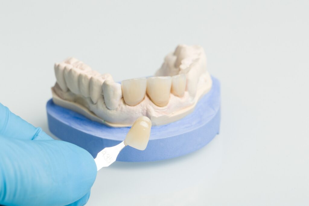 Modern Dentistry of Jupiter | What to Do If Your Dental Crown Chips or Falls Out: A Complete Guide Modern Dentistry of Jupiter | What to Do If Your Dental Crown Chips or Falls Out: A Complete Guide