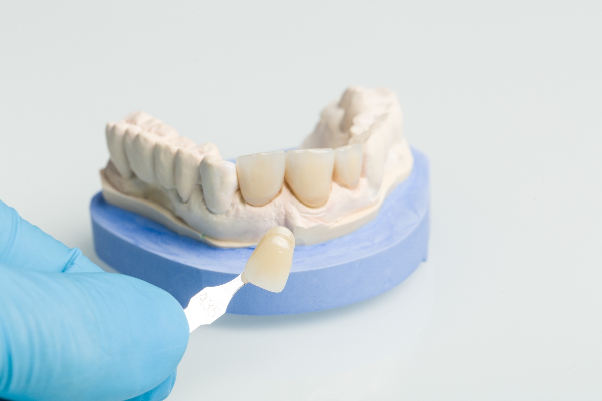 Modern Dentistry of Jupiter | What to Do If Your Dental Crown Chips or Falls Out: A Complete Guide