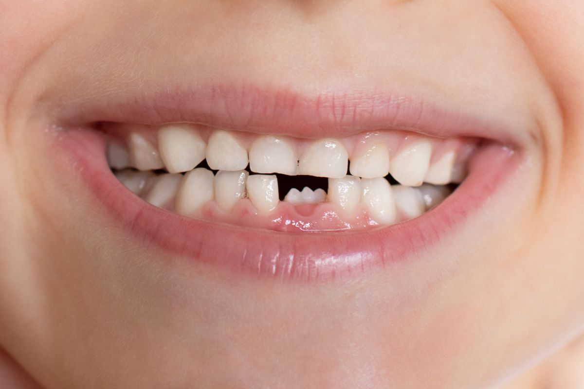 Modern Dentistry of Jupiter | Can Dr. M. Casel fix small, "pegged" teeth with conservative cosmetic options?
