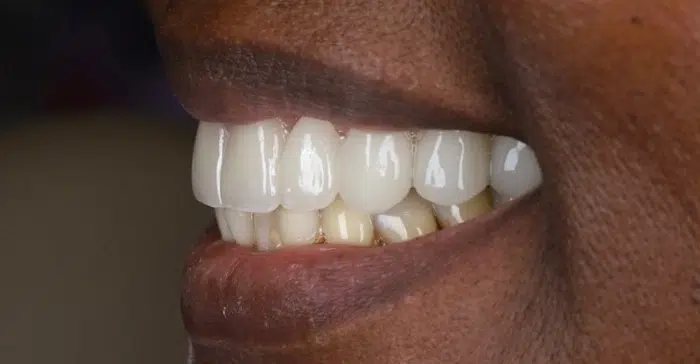 Modern Dentistry of Jupiter | Smile Gallery