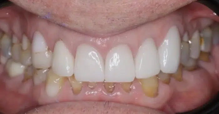 Modern Dentistry of Jupiter | Smile Gallery