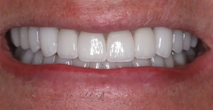 Modern Dentistry of Jupiter | Smile Gallery