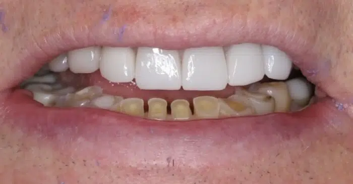 Modern Dentistry of Jupiter | Smile Gallery