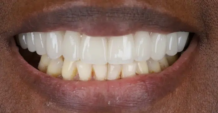 Modern Dentistry of Jupiter | Smile Gallery