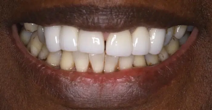 Modern Dentistry of Jupiter | Smile Gallery