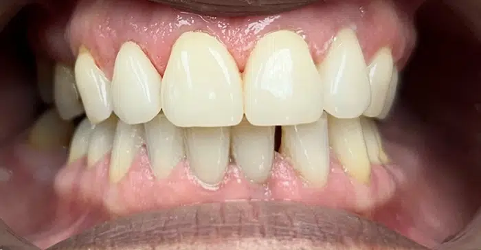 Modern Dentistry of Jupiter | Smile Gallery