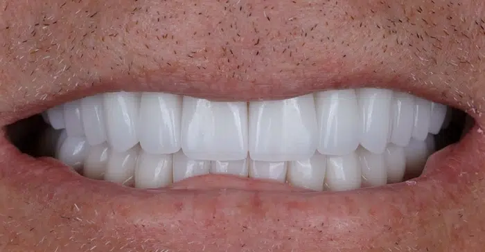 Modern Dentistry of Jupiter | Smile Gallery