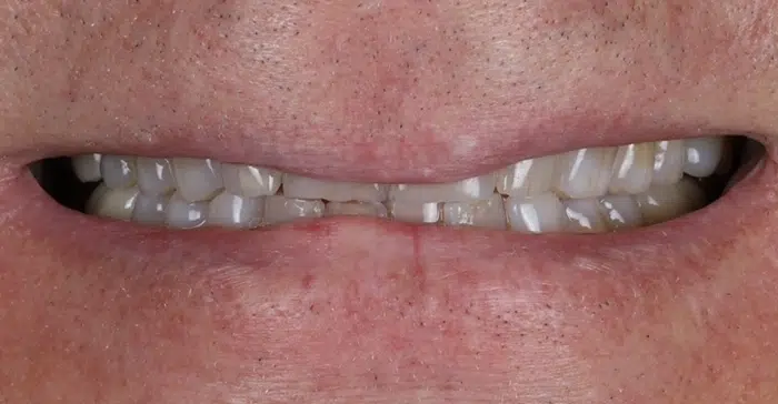 Modern Dentistry of Jupiter | Smile Gallery
