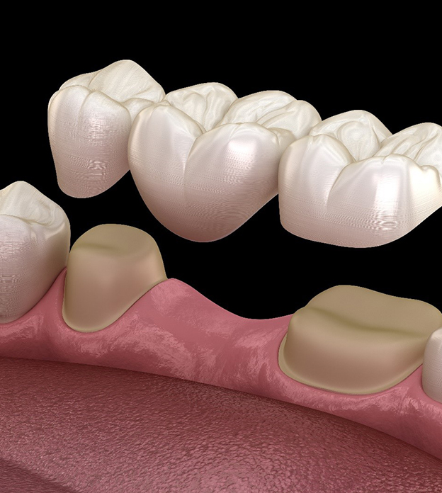 Modern Dentistry of Jupiter | Dental Bridges