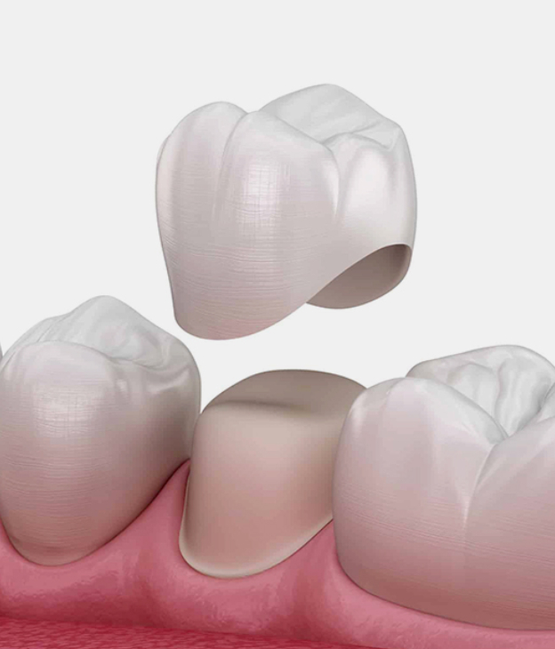 Modern Dentistry of Jupiter | Dental Inlays & Onlays