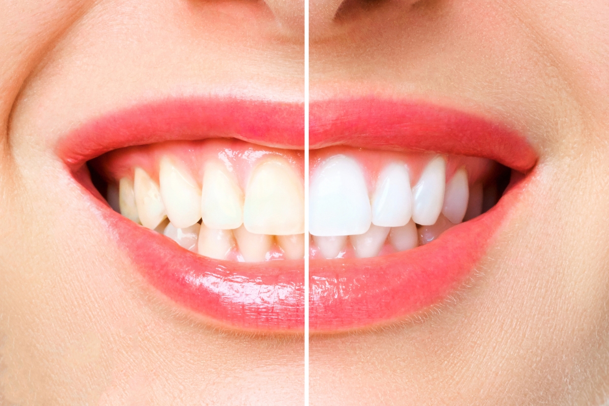 Modern Dentistry of Jupiter | Are veneers reversible if I change my mind? Modern Dentistry of Jupiter | Are veneers reversible if I change my mind?