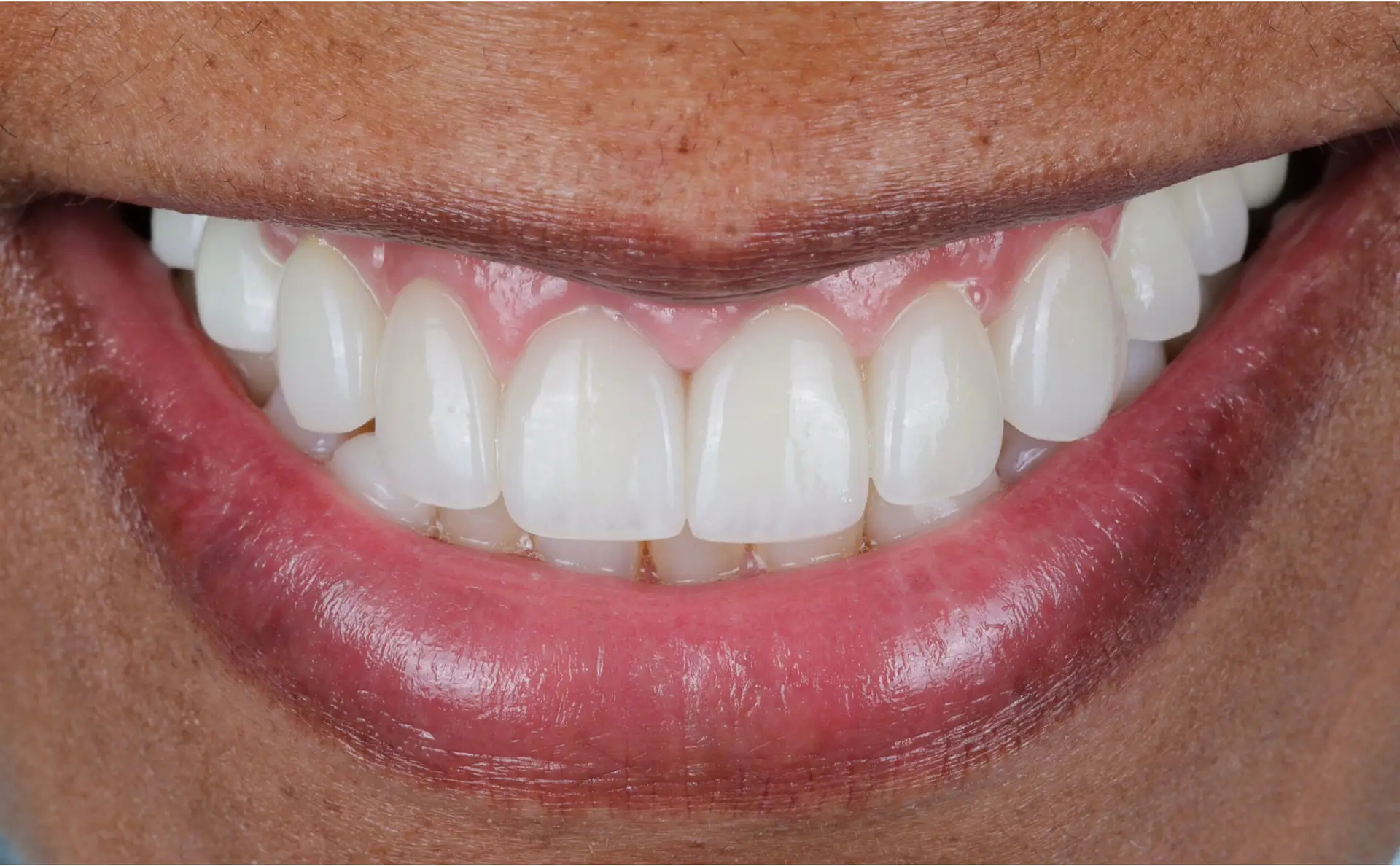 Modern Dentistry of Jupiter | Smile Gallery