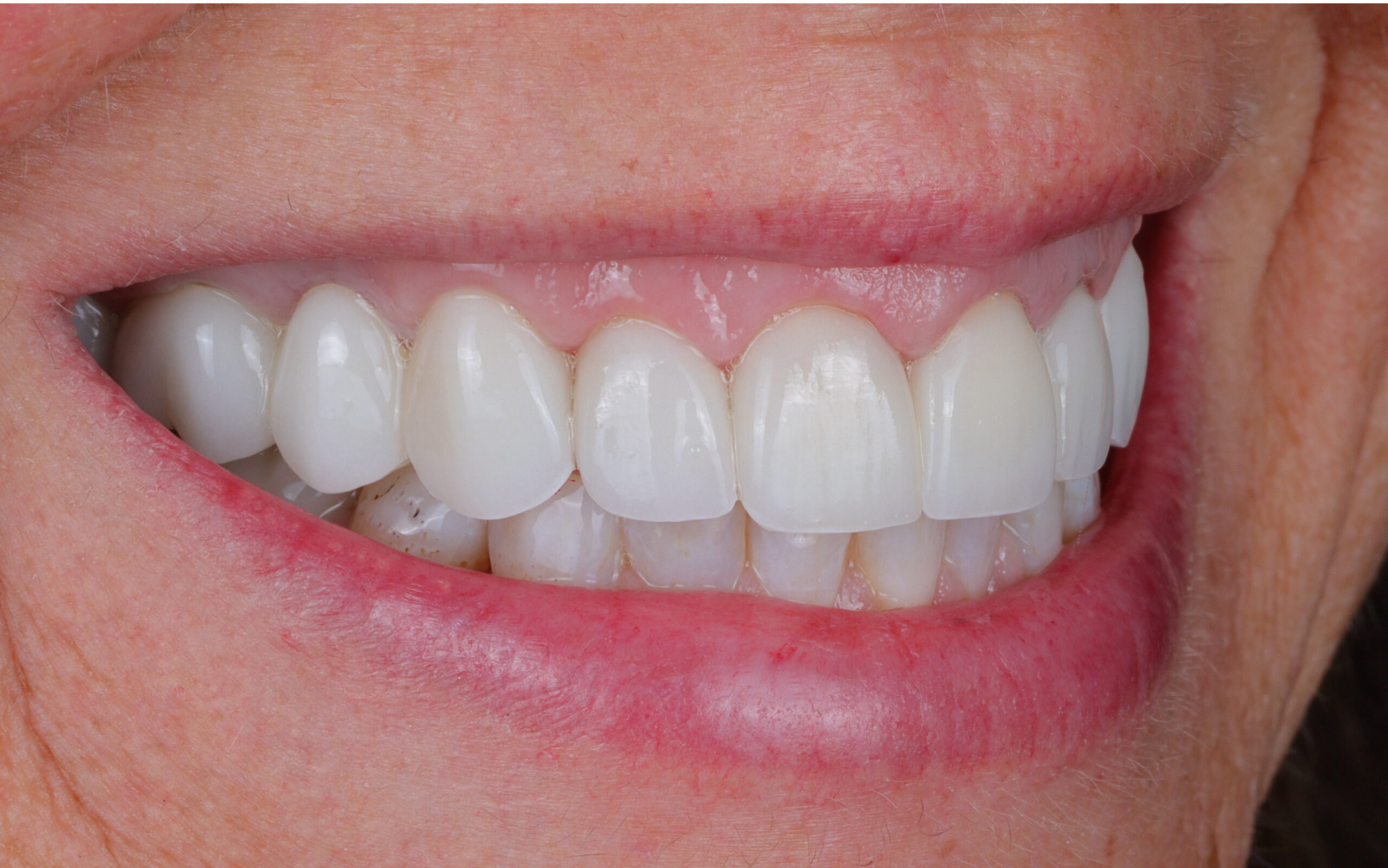 Modern Dentistry of Jupiter | Smile Gallery