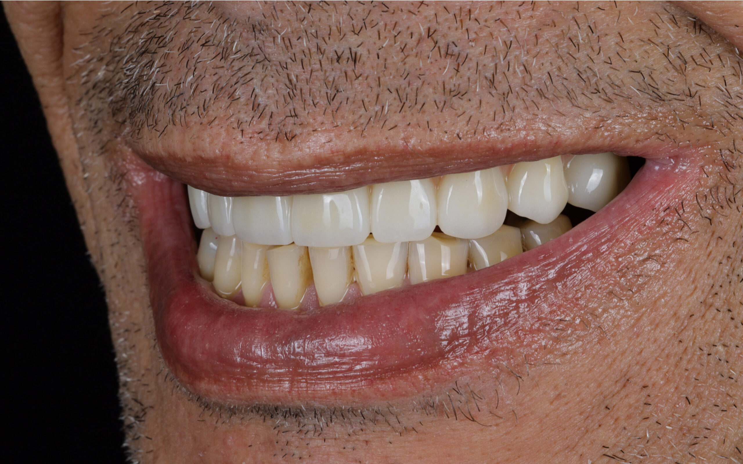 Modern Dentistry of Jupiter | Smile Gallery