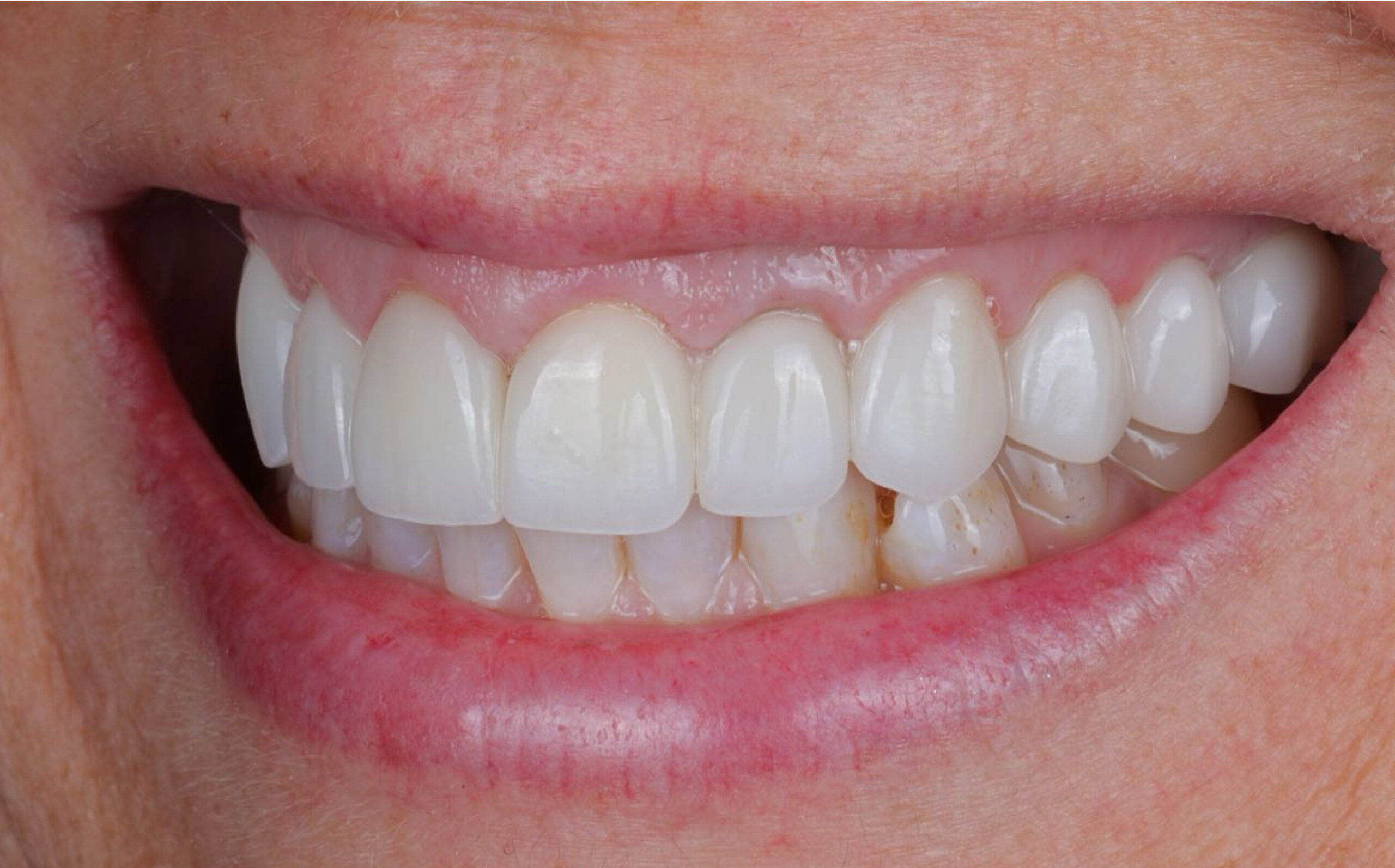 Modern Dentistry of Jupiter | Smile Gallery