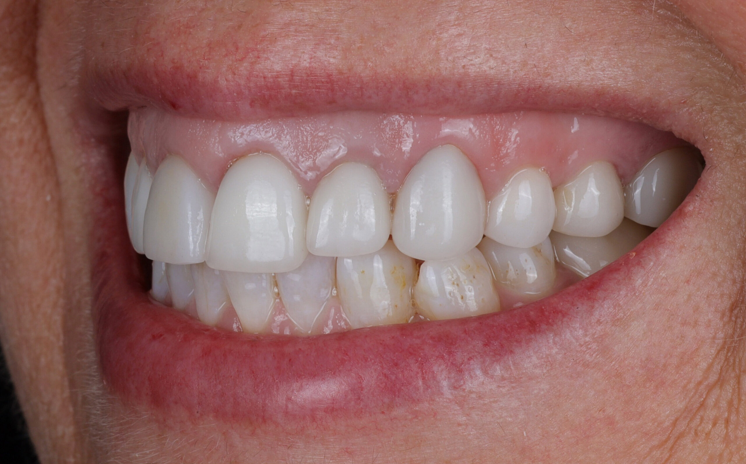 Modern Dentistry of Jupiter | Smile Gallery