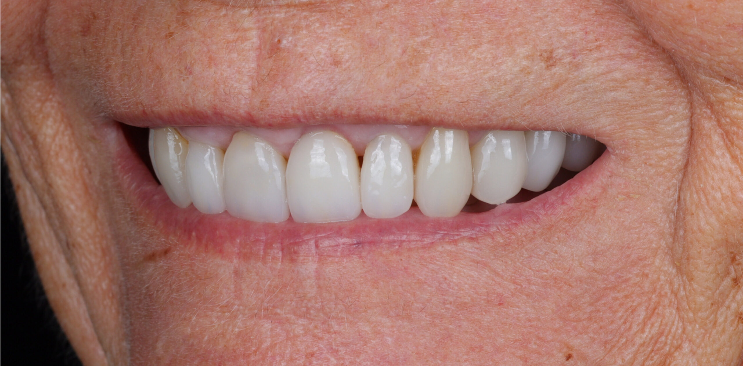 Modern Dentistry of Jupiter | Smile Gallery