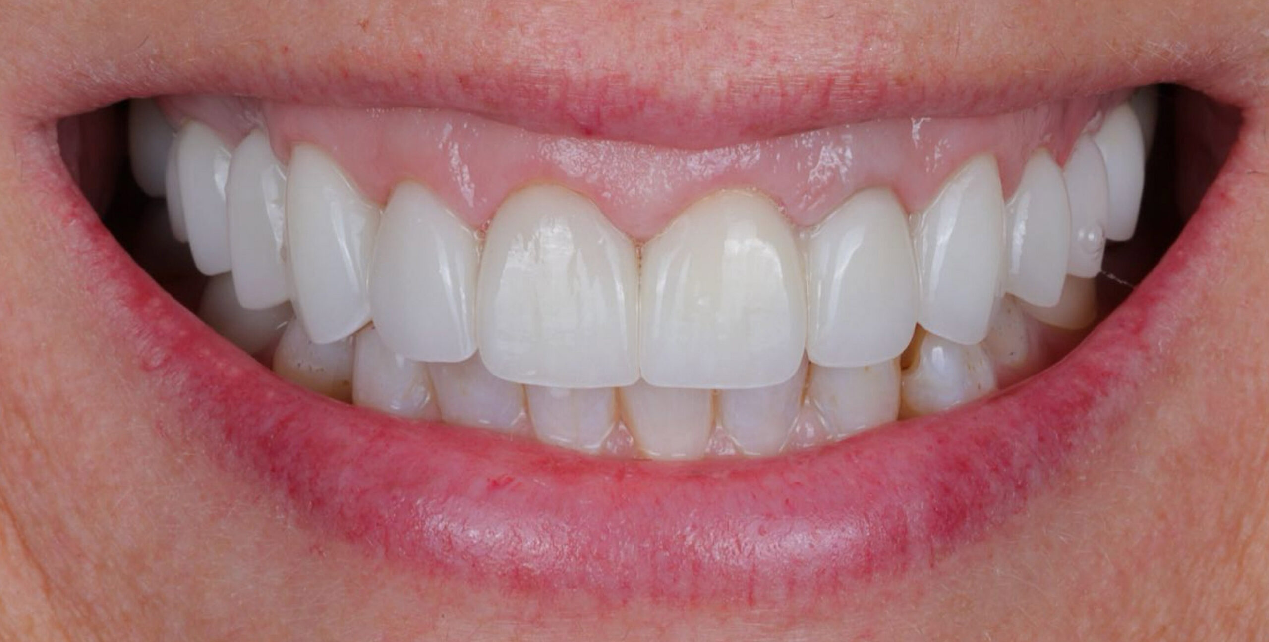 Modern Dentistry of Jupiter | Smile Gallery