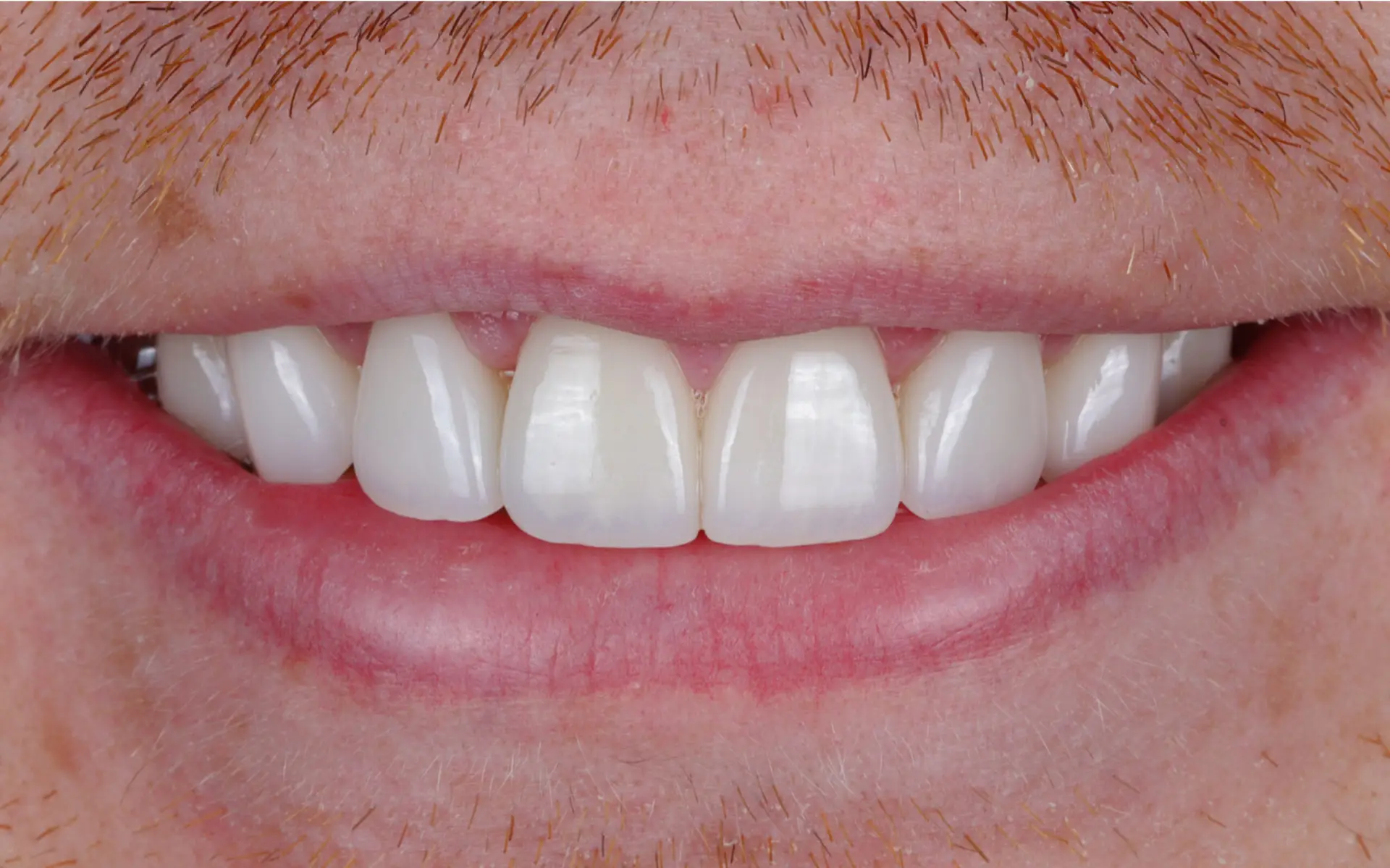Modern Dentistry of Jupiter | Smile Gallery
