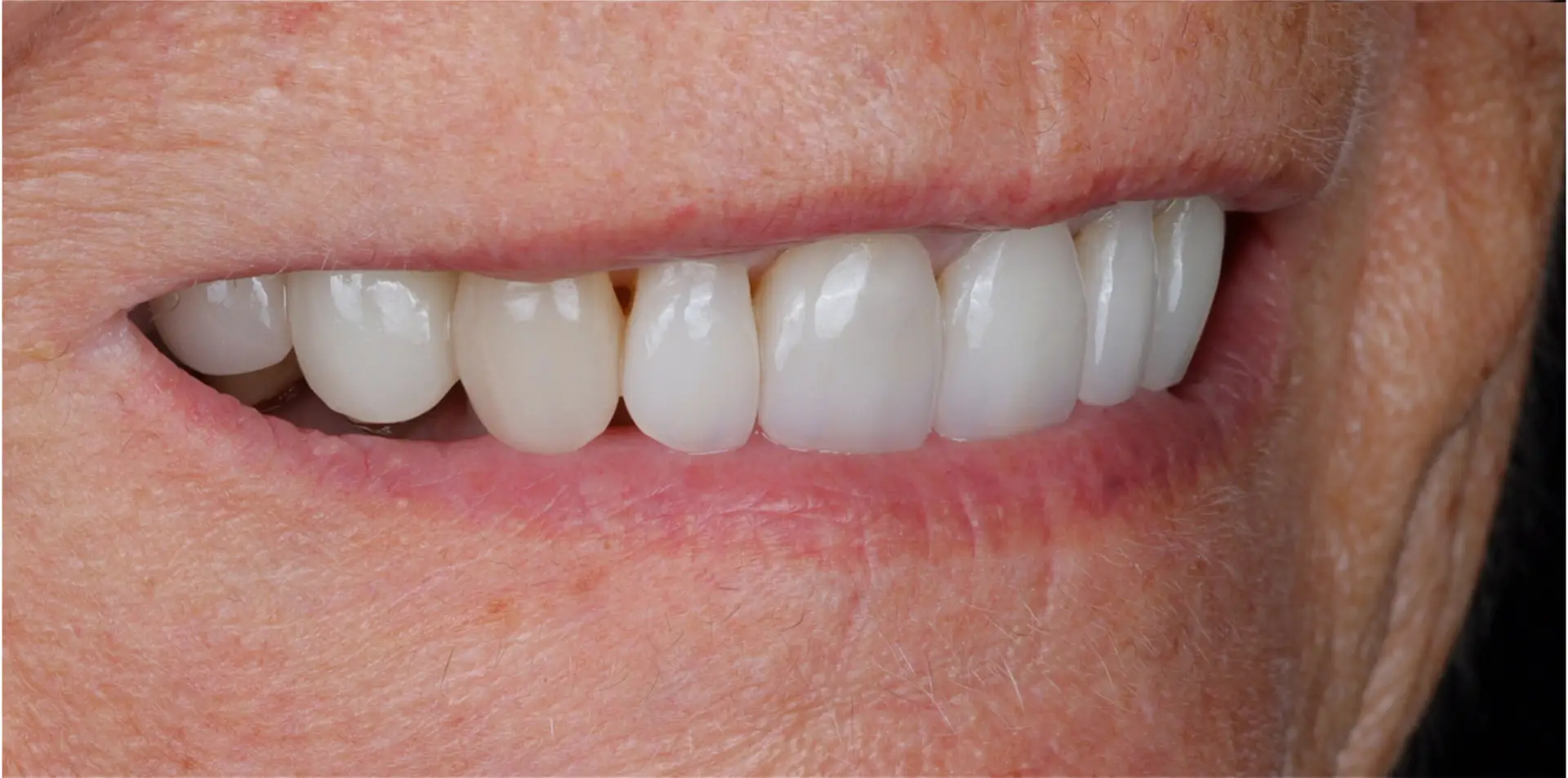 Modern Dentistry of Jupiter | Smile Gallery