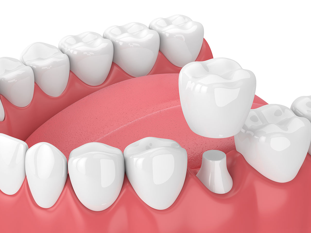 Modern Dentistry of Jupiter | Dental Crowns in Jupiter: When Your Tooth Needs More Than a Filling