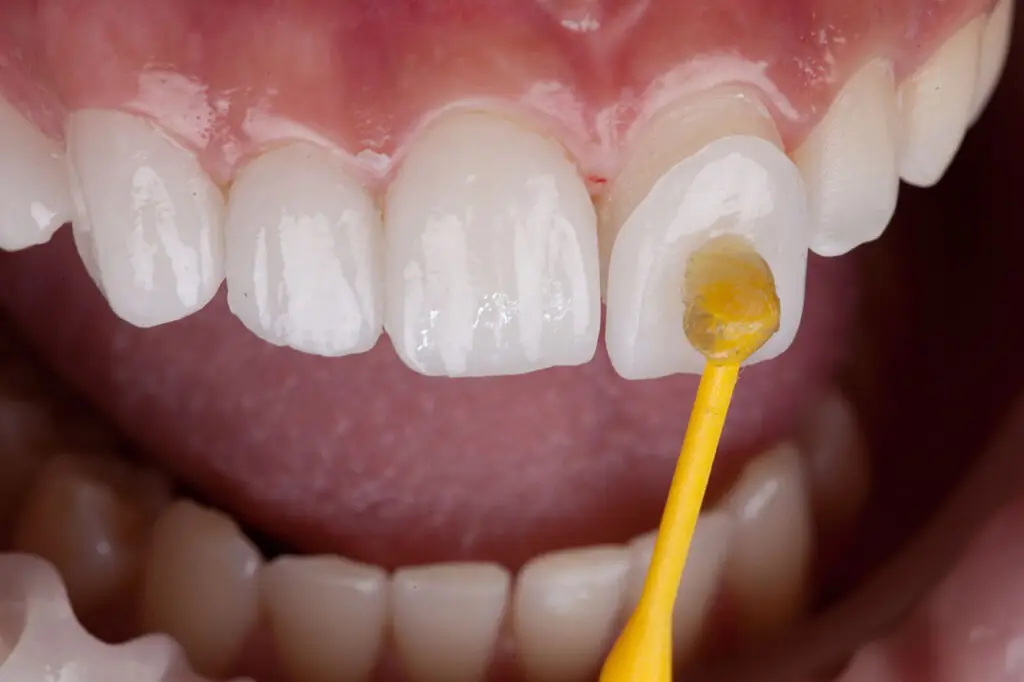 Modern Dentistry of Jupiter | Dental Veneers in Jupiter: How Porcelain Veneers Can Refine Your Smile